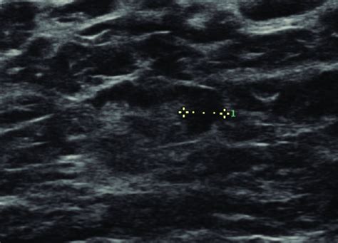 Ultrasound Of An Axillary Lymph Node With Focal Cortical Thickening Or