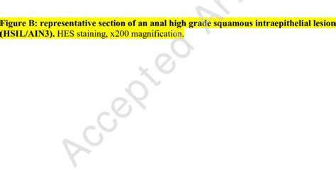Figure A Representative Section Of An Anal Low Grade Squamous