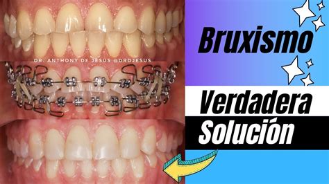 Tratamiento Para El Bruxismo Con Brackets Antes Y Despu S Caso