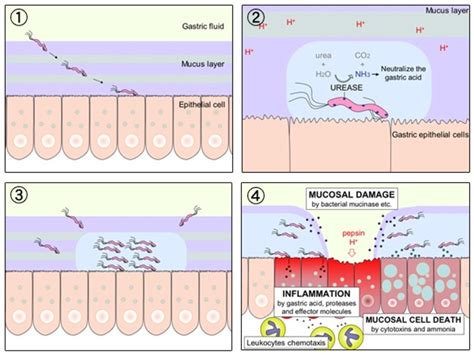 Stomach Or Peptic Ulcers And A Helicobacter Pylori Infection Hubpages