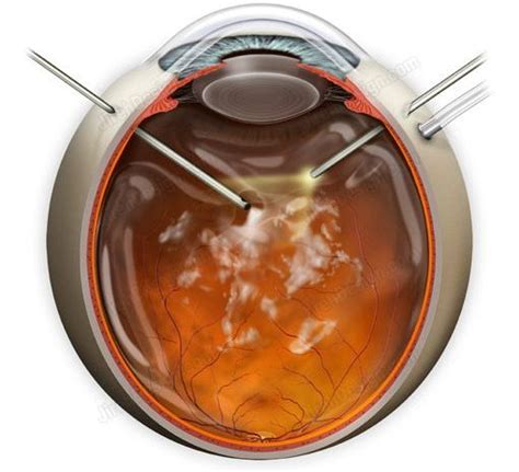 Vitrectomy for floaters #SUVR0020a | Stock eye images