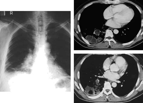 Figure 1 From Infected Cystic Adenomatoid Malformation In An Adult Semantic Scholar