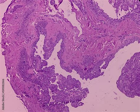 Nodular Cystic Hidradenoma Clear Cell Hidradenoma Nodular Hidradenoma