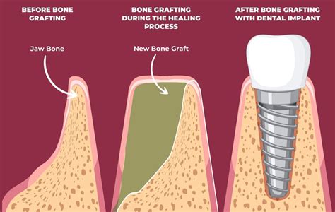 Dental Bone Graft: Restoring Oral Health - Dentaprime UK