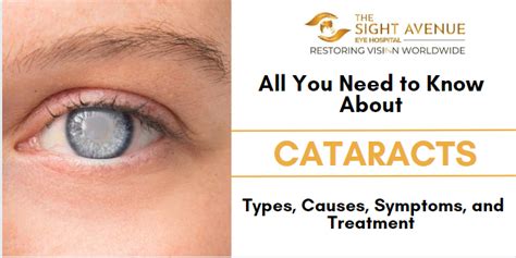 A Complete Guide To Cataracts Types Symptoms And Treatments