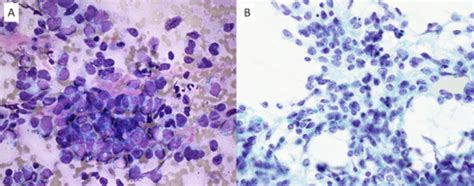 Tumor Cells Had Large Round To Ovoid Hyperchromatic Nuclei With