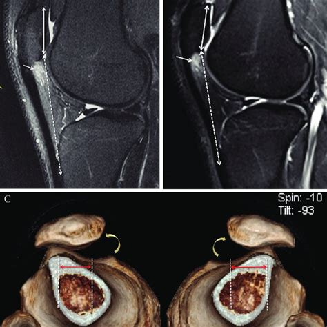 Pdf Mri Findings Consistent With Peripatellar Fat Pad Impingement