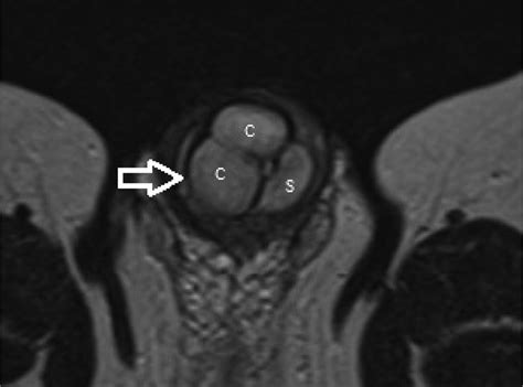 Axial T2 Weighted Tse Mr Imaging On Treatment 6 Months Later