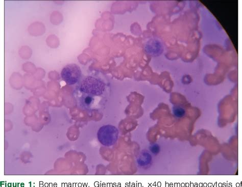 Figure 1 From Hemophagocytic Syndrome Secondary To Plasmodium Vivax