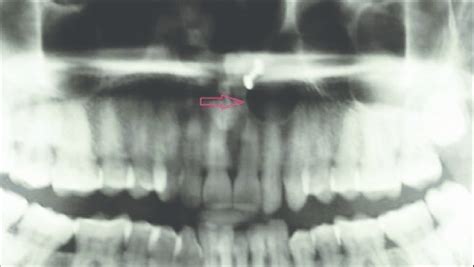 Orthopantomogram Showing Well Defi Ned Unilocular Radiolucency In The