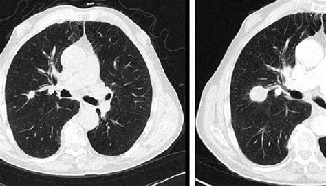 Lung Cancer Screening Key Elements Of A Succesful Program