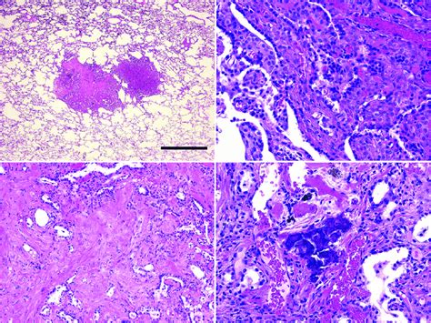 Pathological Findings Of Sclerosing Hemangioma A Sclerosing