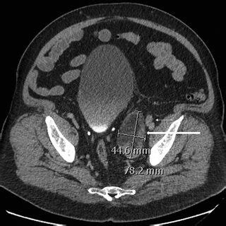 Axial Section Of Contrast Enhanced CT Scan Of Pelvis Showing A 7 8