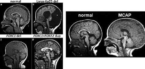 Causes & Symptoms - Alexander Disease