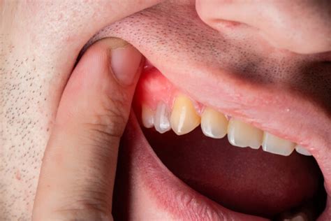 Swollen Gum Around One Tooth Cause And Treatment Options