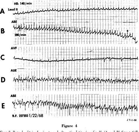 Figure 4 From Treatment Of Supraventricular Tachycardias By Rapid Atrial Stimulation Semantic