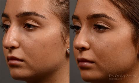 400d Expert Rhinoplasty Surgeon Rhinoplasty Dr Oakley Smith Toronto