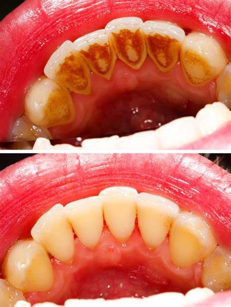 Scale And Cleaning North Road Dental Clinic