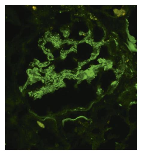 Immunofluorescence Microscopy Granular Predominantly Mesangial