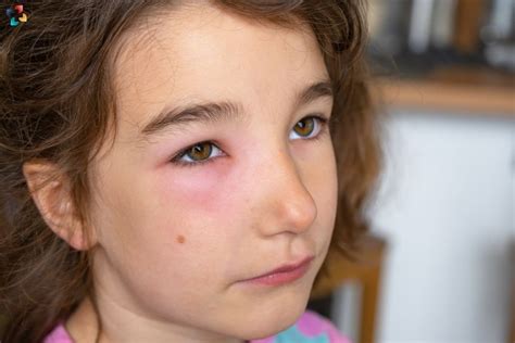 Chalazion Vs Hordeolum Differences Causes Symptoms And Treatment