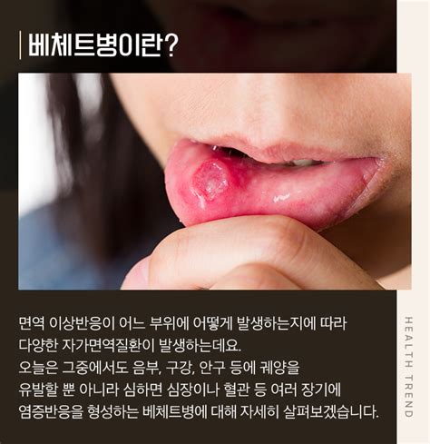 내 면역세포가 나를 공격 자가면역질환 베체트병 네이버 포스트