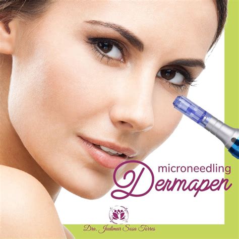 Conocen El Microneedling Esta Es Una T Cnica M Nimamente Invasiva