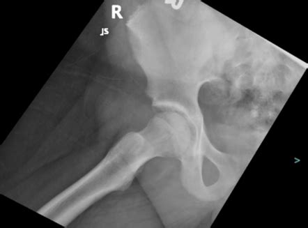 Slipped Capital Femoral Epiphysis Scfe Image Radiopaedia Org