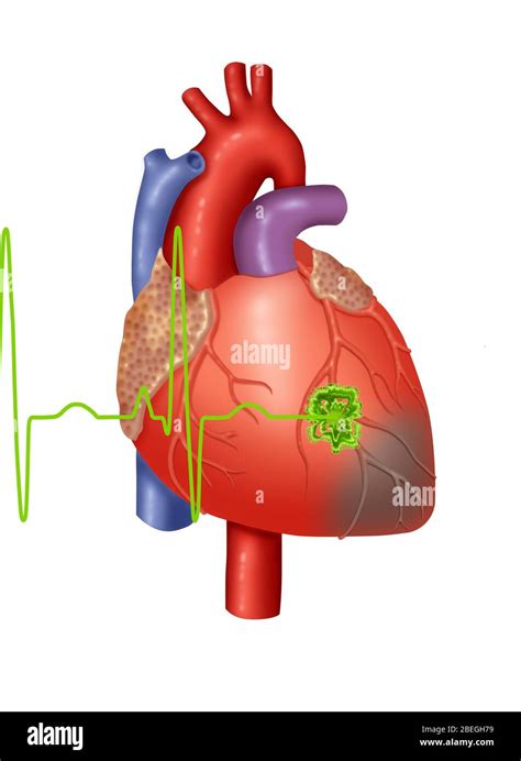 Myocardial Infarction Ecg Banque De Photographies Et Dimages Haute