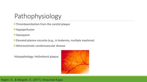 Amaurosis Fugax Ppt