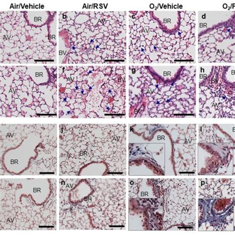 Differential Pulmonary Histopathology After Respiratory Syncytial Virus