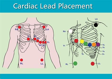 Premium Vector | Cardiac Lead Placement