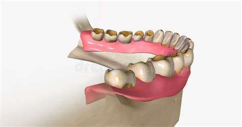 Dental Erosion, Also Known As Tooth Erosion Stock Illustration ...