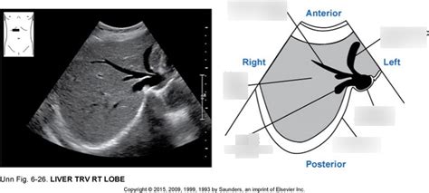 Liver Trans Right Lobe Diagram Quizlet