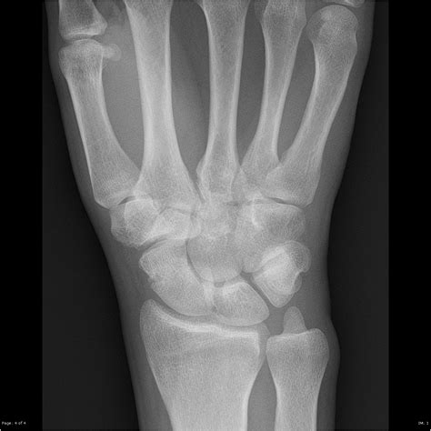 Scaphoid Fracture Image