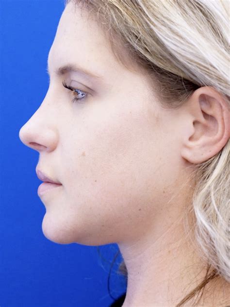 Cases In Rhinoplasty Endonasal Mao Facial Plastics