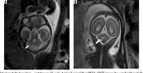 Figure 9 From Imaging Spectrum Of Posterior Fossa Anomalies On Foetal