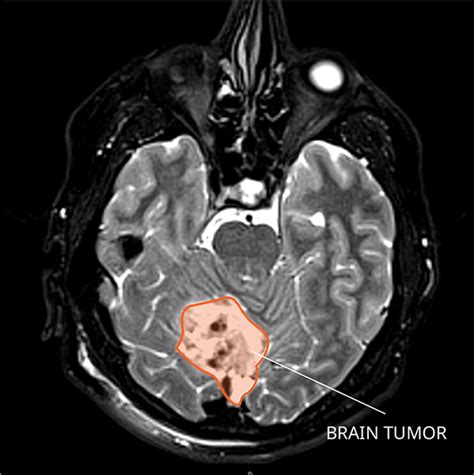 Medulloblastoma National Cancer Institute