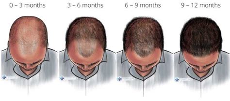 Understanding Finasteride: Results Timeline and How Long It Takes to Work