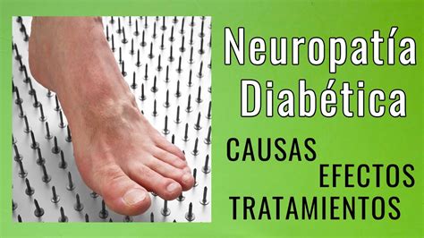 La Neuropatía Diabética Youtube