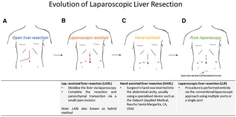 Evolution Of Laparoscopic Liver Resection Exemplary Illustration Of