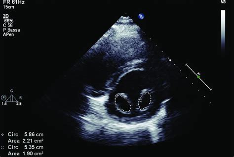 Parasternal Short Axis View At The Level Of The Mitral Valve In