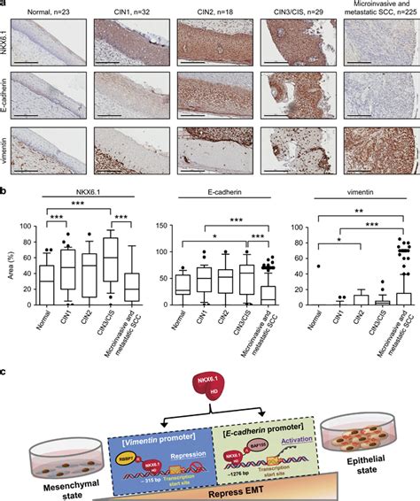 Clinical Correlation Of NKX6 1 And E Cadherin Or Vimentin Expression