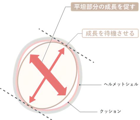 赤ちゃんの頭の形を矯正するヘルメット「ベビーバンド」─愛知・岐阜・長崎の医療機関で初導入、30以上の施設で順次提供 知財図鑑