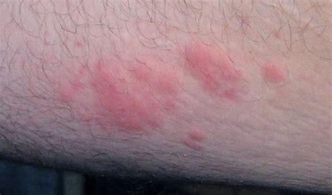 Stress Rash Pictures | Medical Pictures and Images - (2023 Updated)