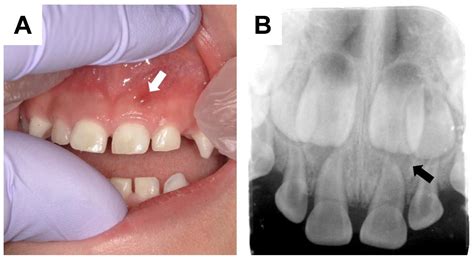 Endocrines Free Full Text Dental Manifestations And Oral Management