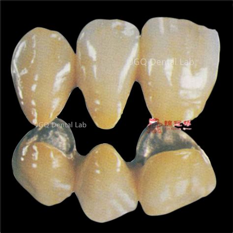 Metal Fused To Porcelain Ceramic Implant Pfm Crowns Bridge From China