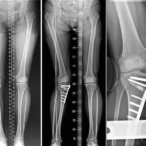 Valgus Overcorrection After Open Wedge High Tibial Osteotomy Hto With