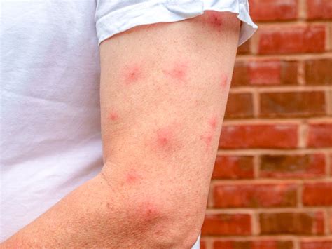 Mosquito Bite Blisters Cause And Treatments