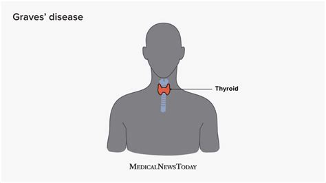 Graves Disease Symptoms Treatment And Causes