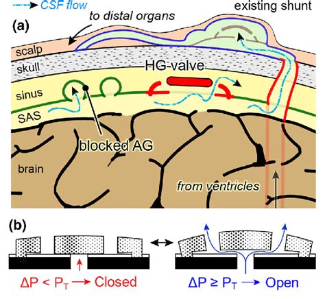 (a) Obstructed CSF flow in hydrocephalus and methods to introduce ...